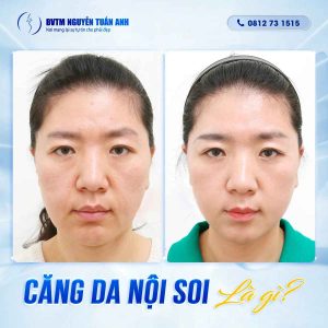 Căng da nội soi ở đâu an toàn?