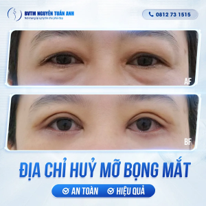 Địa chỉ huỷ mỡ bọng mắt an toàn và hiệu quả