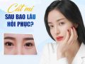 Lưu ý sau khi phẫu thuật thẩm mỹ mí mắt