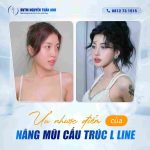 Ưu Nhược Điểm Của Nâng Mũi Cấu Trúc L Line