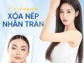 Các phương pháp căng da trán phổ biến hiện nay